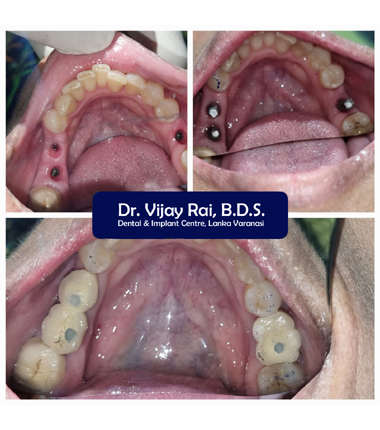 Dental & Implant Center, Lanka Varanasi | Operated Cases 18 