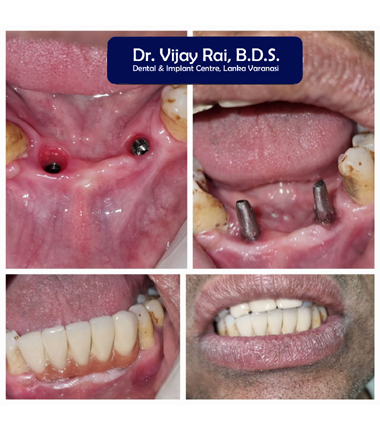 Dental & Implant Center, Lanka Varanasi | Operated Cases 20 