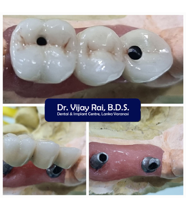 Dental & Implant Center, Lanka Varanasi | Operated Cases 21 