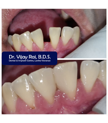 Dental & Implant Center, Lanka Varanasi | Operated Cases 23 
