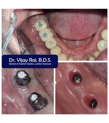 Dental & Implant Center, Lanka Varanasi | Operated Cases 25 