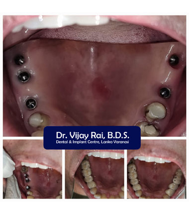 Dental & Implant Center, Lanka Varanasi | Operated Cases 26 